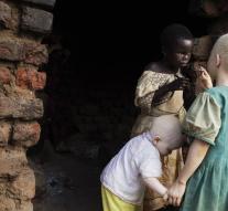 Senegal develops sunscreen for albinos