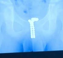 12-year-old boy stops 'out of curiosity' 39 magnetic balls in urethra