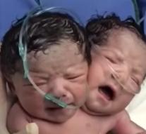Baby with two heads born
