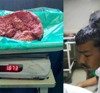 Brain tumor of 1.8 kilos removed in men: 'lay 2 heads together'