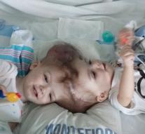 Conjoined twins successfully operated
