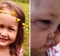 Dog attacks: girl (4) has a skull fracture