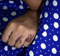 Indian woman five times victim of acid attack