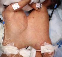 Separation Siamese twins' medical sensation '