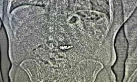 Jewel Thief Swallows Valuable Earrings During Arrest, Jeweler to Retrieve Them After Toilet Visit