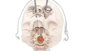 Medical Breakthrough: Surgeons Remove Spinal Tumor via Eye Socket