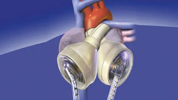 First Artificial Heart Patient Survives 100 Days