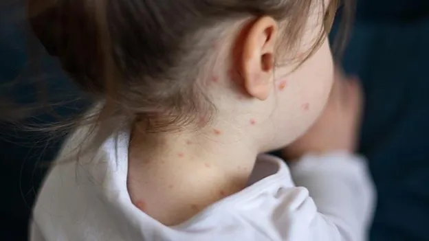 First Measles-Related Death in 10 Years in the US