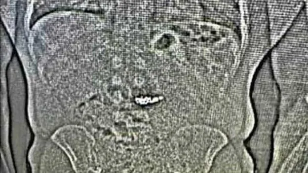 Jewel Thief Swallows Valuable Earrings During Arrest, Jeweler to Retrieve Them After Toilet Visit