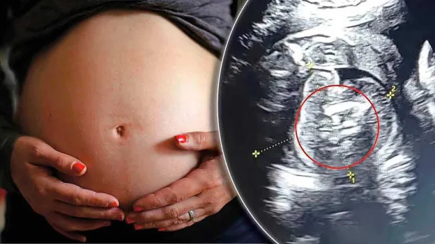 Rare Phenomenon in India: Two Extra Fetuses Found in Baby During Pregnancy