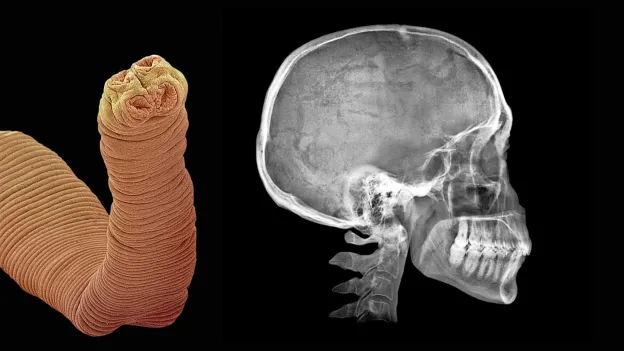 Shocking Incident of American Woman Ordering Tapeworm Eggs on Dark Web for Weight Loss
